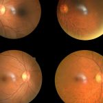 riscos do descolamento de retina em curitiba