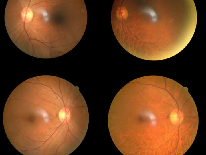 riscos do descolamento de retina em curitiba