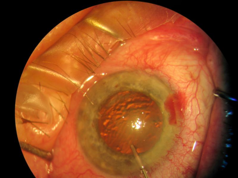 cirurgias de retina em curitiba melhor médicio especialista