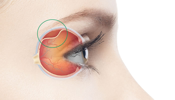 tratamento de descolamento de retina em curitiba
