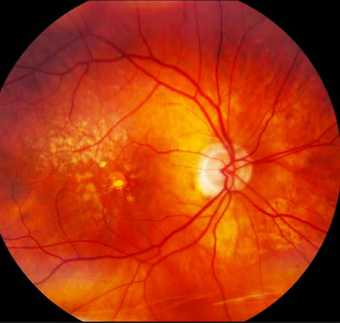 tratamento de dmri em curitiba cirurgias de retina